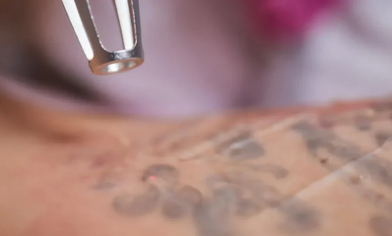 The Science Behind Tattoo Ink How It Impacts Removal Technique